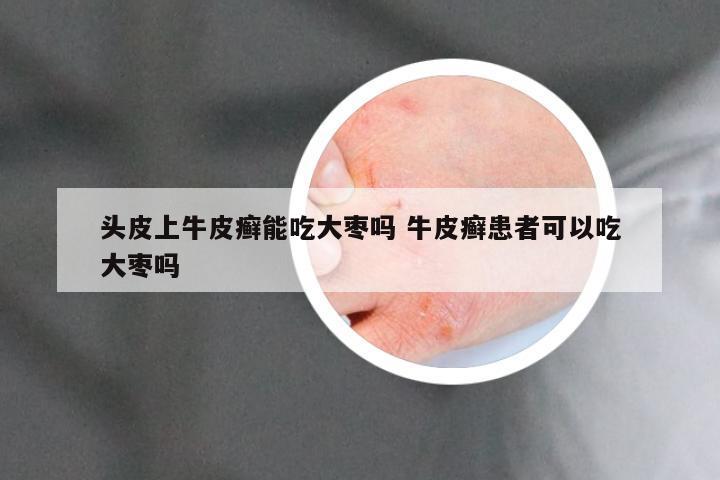 头皮上牛皮癣能吃大枣吗 牛皮癣患者可以吃大枣吗