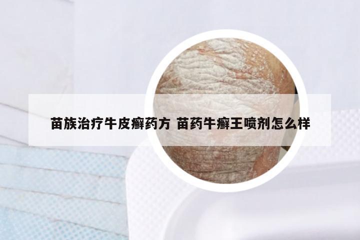 苗族治疗牛皮癣药方 苗药牛癣王喷剂怎么样