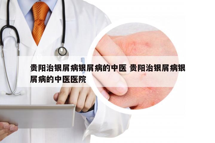 贵阳治银屑病银屑病的中医 贵阳治银屑病银屑病的中医医院