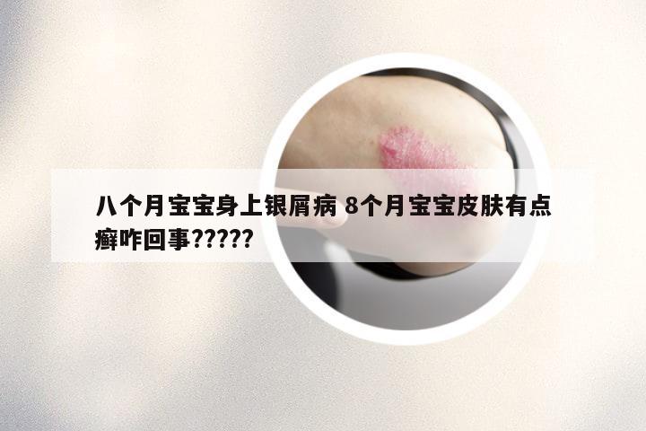 八个月宝宝身上银屑病 8个月宝宝皮肤有点癣咋回事?????