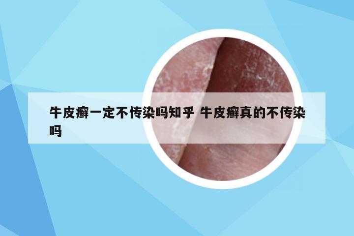 牛皮癣一定不传染吗知乎 牛皮癣真的不传染吗
