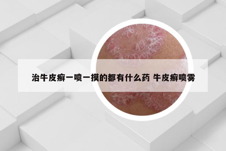治牛皮癣一喷一摸的都有什么药 牛皮癣喷雾