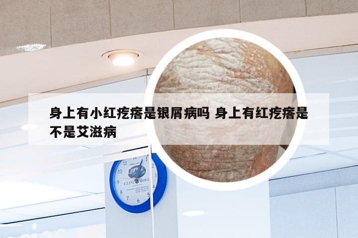 身上有小红疙瘩是银屑病吗 身上有红疙瘩是不是艾滋病