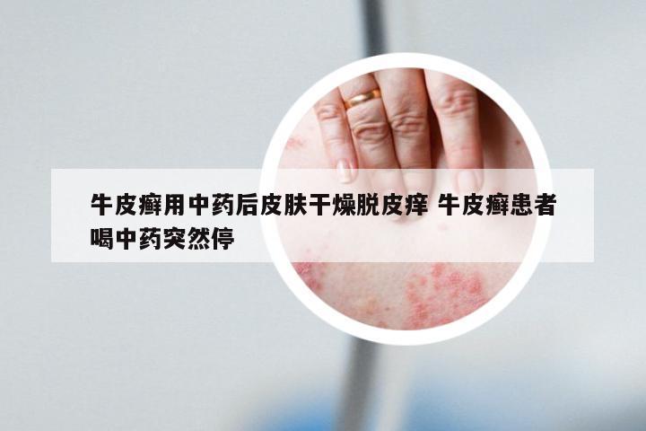 牛皮癣用中药后皮肤干燥脱皮痒 牛皮癣患者喝中药突然停
