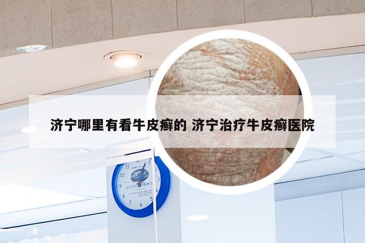 济宁哪里有看牛皮癣的 济宁治疗牛皮癣医院