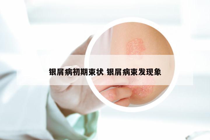 银屑病初期束状 银屑病束发现象