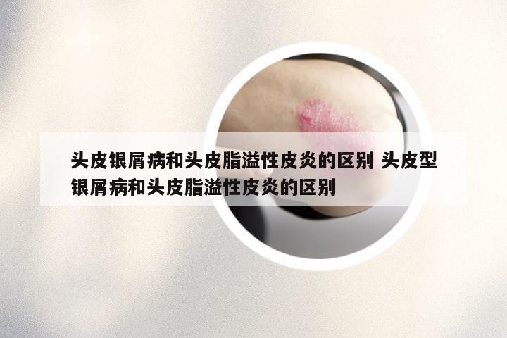 头皮银屑病和头皮脂溢性皮炎的区别 头皮型银屑病和头皮脂溢性皮炎的区别