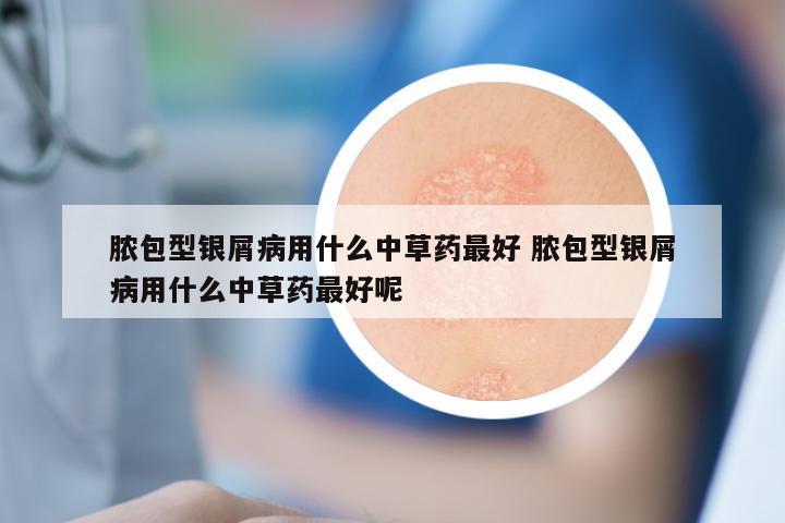 脓包型银屑病用什么中草药最好 脓包型银屑病用什么中草药最好呢
