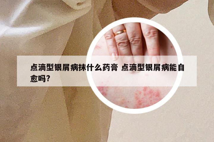 点滴型银屑病抹什么药膏 点滴型银屑病能自愈吗?