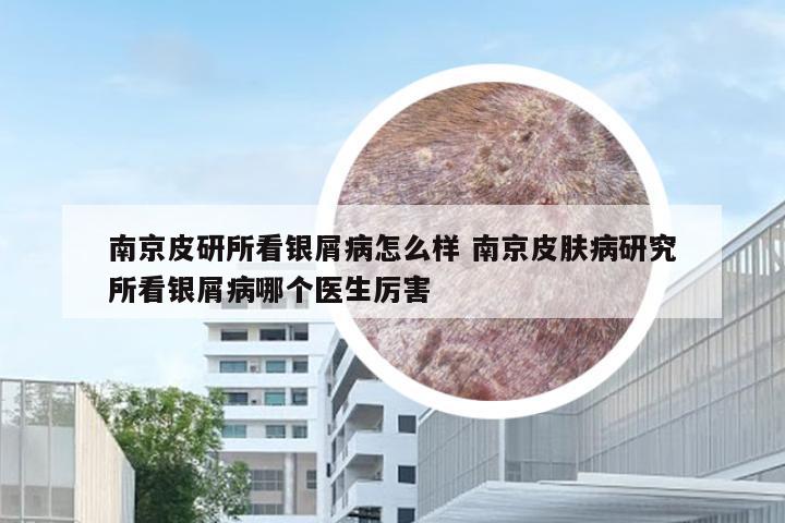 南京皮研所看银屑病怎么样 南京皮肤病研究所看银屑病哪个医生厉害