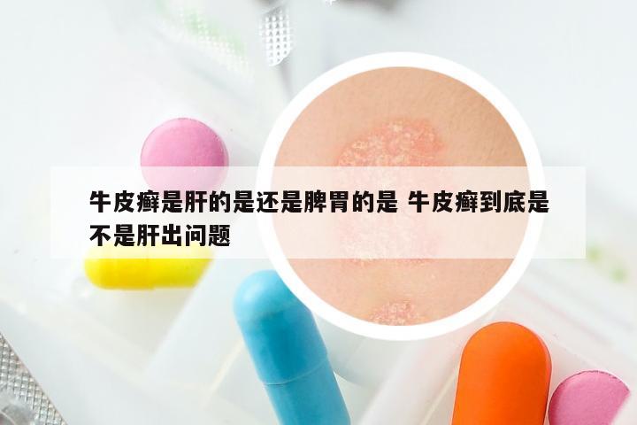 牛皮癣是肝的是还是脾胃的是 牛皮癣到底是不是肝出问题