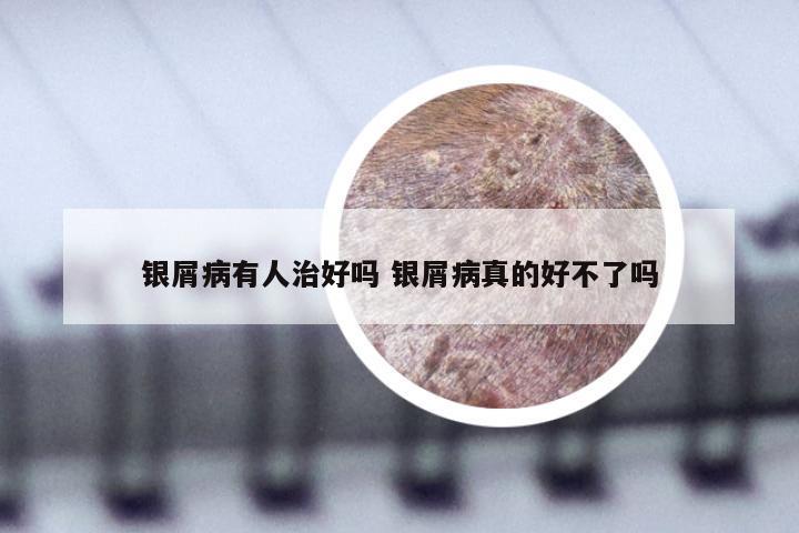 银屑病有人治好吗 银屑病真的好不了吗