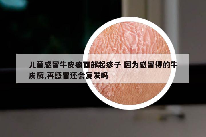 儿童感冒牛皮癣面部起疹子 因为感冒得的牛皮癣,再感冒还会复发吗