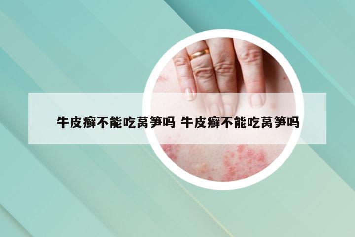 牛皮癣不能吃莴笋吗 牛皮癣不能吃莴笋吗