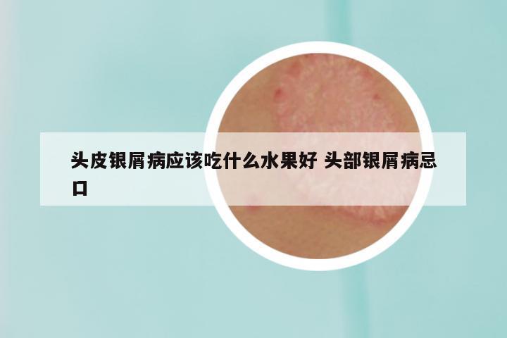 头皮银屑病应该吃什么水果好 头部银屑病忌口