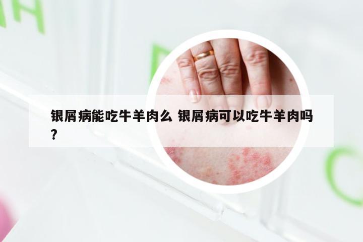 银屑病能吃牛羊肉么 银屑病可以吃牛羊肉吗?