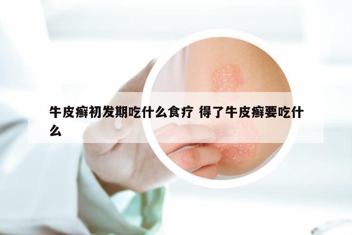牛皮癣初发期吃什么食疗 得了牛皮癣要吃什么