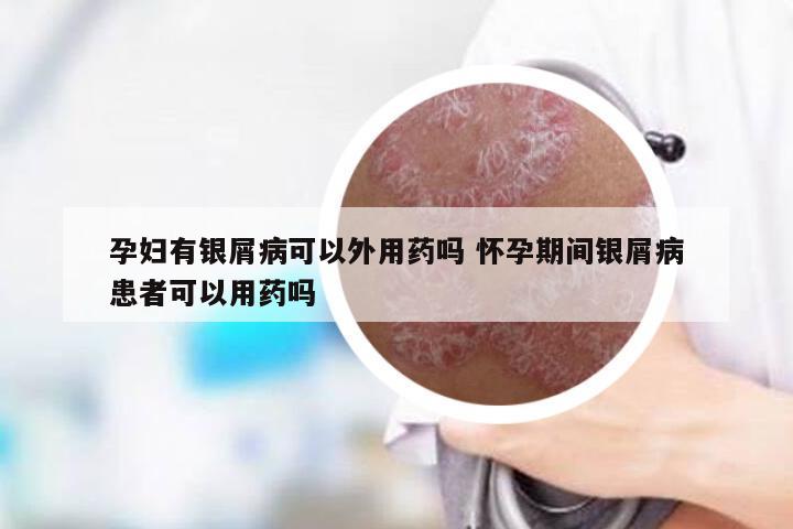 孕妇有银屑病可以外用药吗 怀孕期间银屑病患者可以用药吗