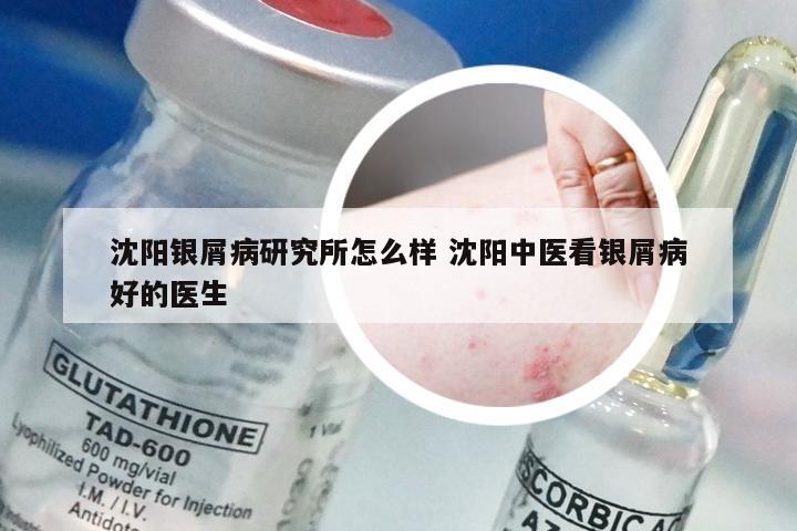 沈阳银屑病研究所怎么样 沈阳中医看银屑病好的医生