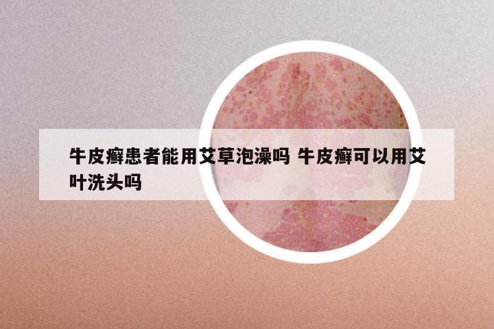 牛皮癣患者能用艾草泡澡吗 牛皮癣可以用艾叶洗头吗