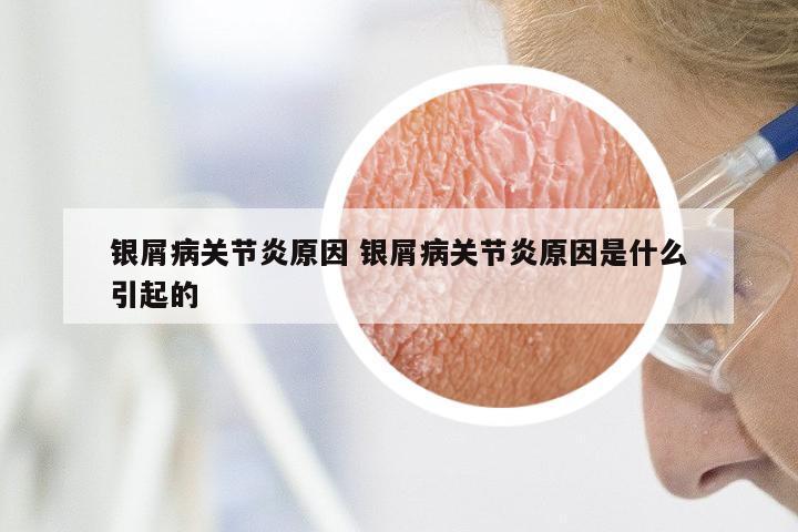 银屑病关节炎原因 银屑病关节炎原因是什么引起的