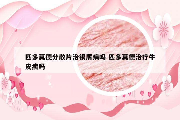 匹多莫德分散片治银屑病吗 匹多莫德治疗牛皮癣吗