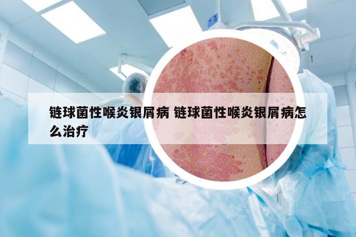 链球菌性喉炎银屑病 链球菌性喉炎银屑病怎么治疗