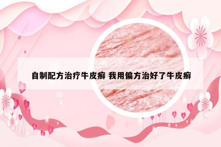 自制配方治疗牛皮癣 我用偏方治好了牛皮癣