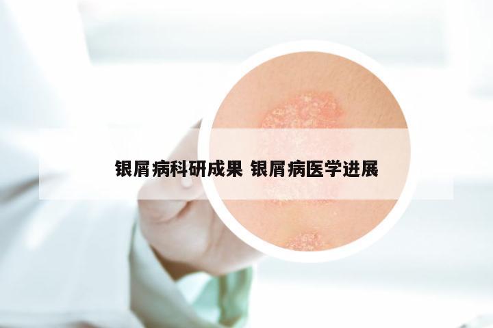 银屑病科研成果 银屑病医学进展