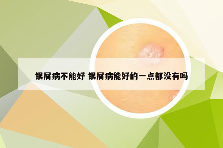 银屑病不能好 银屑病能好的一点都没有吗