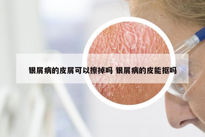 银屑病的皮屑可以擦掉吗 银屑病的皮能抠吗