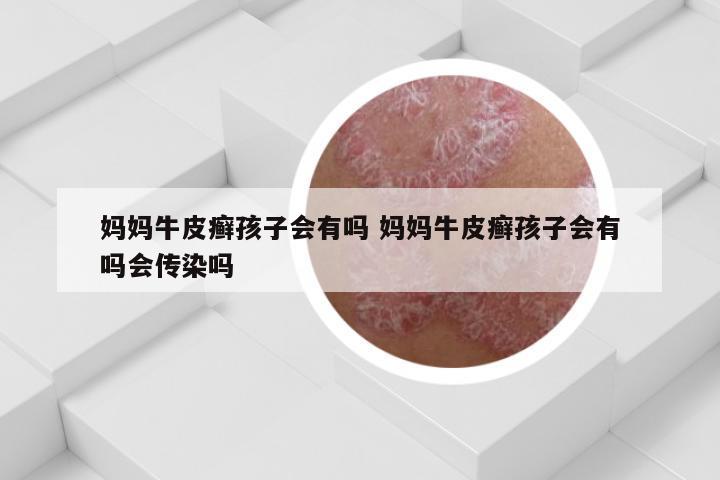 妈妈牛皮癣孩子会有吗 妈妈牛皮癣孩子会有吗会传染吗