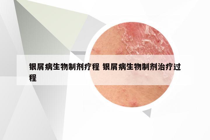 银屑病生物制剂疗程 银屑病生物制剂治疗过程
