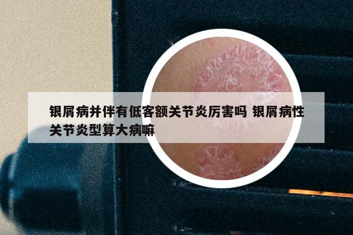 银屑病并伴有低客额关节炎厉害吗 银屑病性关节炎型算大病嘛