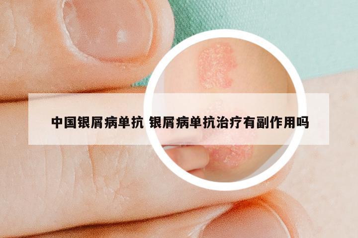 中国银屑病单抗 银屑病单抗治疗有副作用吗