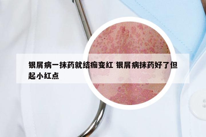 银屑病一抹药就结痂变红 银屑病抹药好了但起小红点
