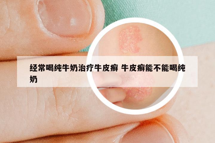 经常喝纯牛奶治疗牛皮癣 牛皮癣能不能喝纯奶