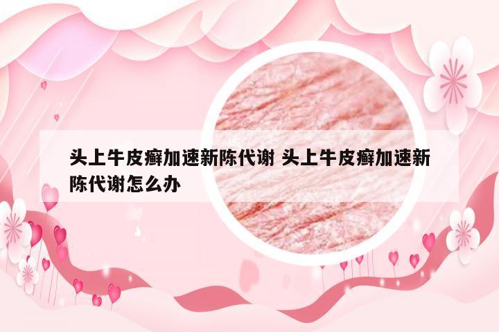 头上牛皮癣加速新陈代谢 头上牛皮癣加速新陈代谢怎么办