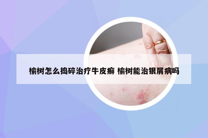 榆树怎么捣碎治疗牛皮癣 榆树能治银屑病吗