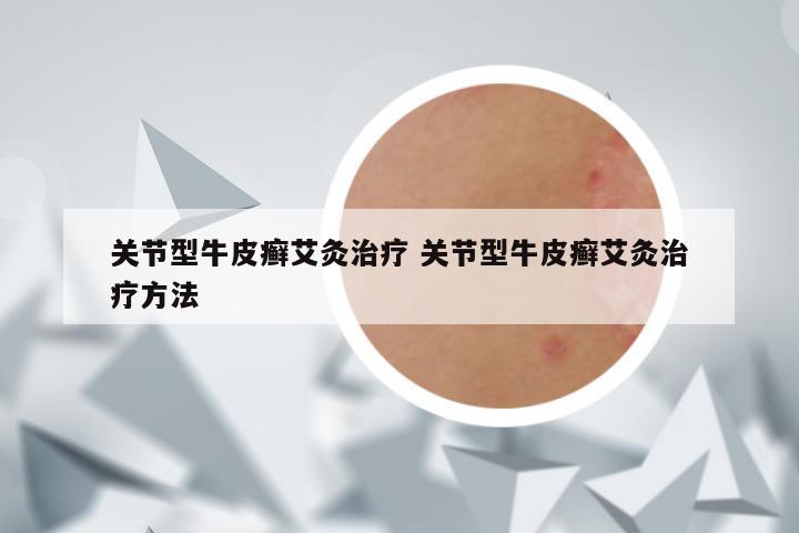 关节型牛皮癣艾灸治疗 关节型牛皮癣艾灸治疗方法