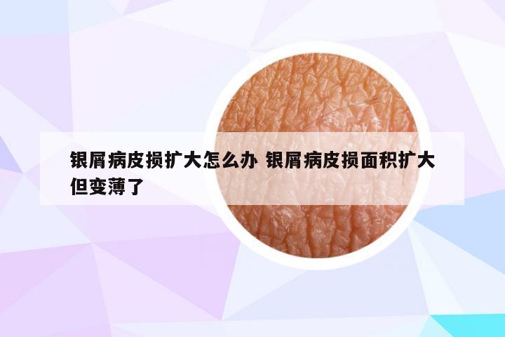 银屑病皮损扩大怎么办 银屑病皮损面积扩大但变薄了
