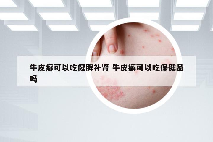 牛皮癣可以吃健脾补肾 牛皮癣可以吃保健品吗