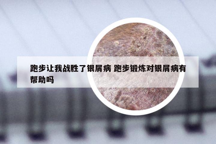 跑步让我战胜了银屑病 跑步锻炼对银屑病有帮助吗