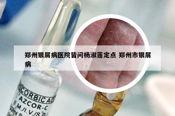 郑州银屑病医院皆问杨淑莲定点 郑州市银屑病