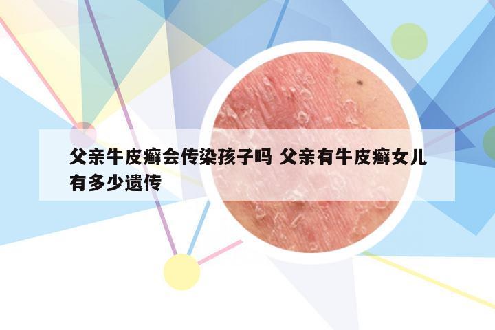父亲牛皮癣会传染孩子吗 父亲有牛皮癣女儿有多少遗传