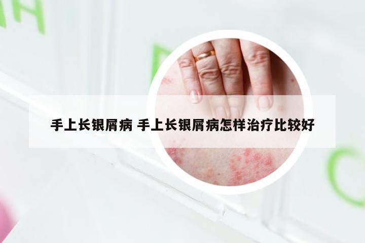 手上长银屑病 手上长银屑病怎样治疗比较好