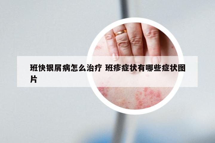 班快银屑病怎么治疗 班疹症状有哪些症状图片