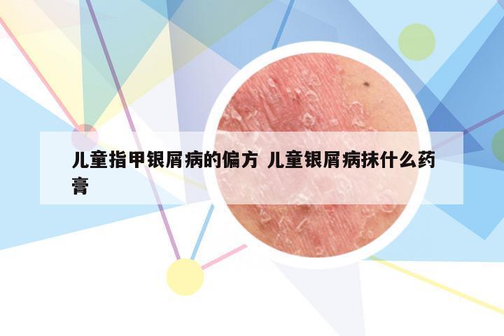 儿童指甲银屑病的偏方 儿童银屑病抹什么药膏