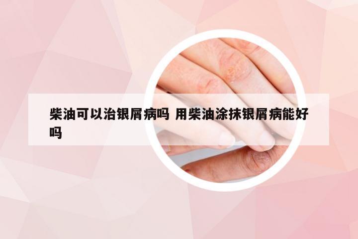 柴油可以治银屑病吗 用柴油涂抹银屑病能好吗