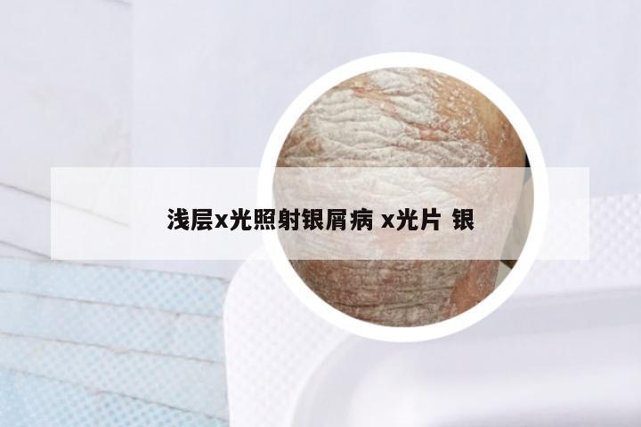 浅层x光照射银屑病 x光片 银